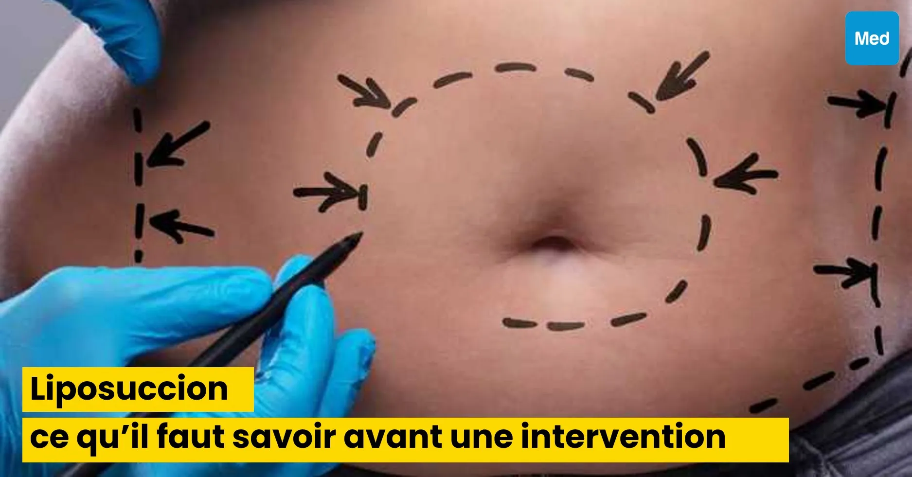 Liposuccion : ce qu’il faut savoir avant une intervention